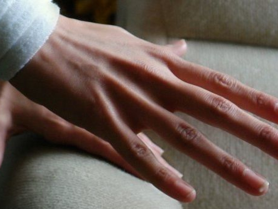 В Запорожье у травматологов аншлаг: люди массово ломают конечности