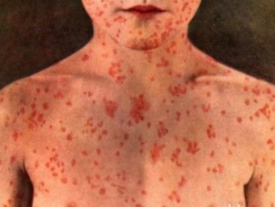 В запорожском СИЗО зафиксировали вспышку кори среди заключенных 