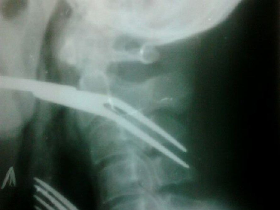 В Запорожье мужчина спасался вилкой от удушья... и проглотил ее