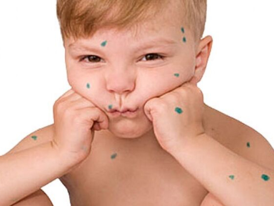 В Запорожье с начала года ветрянкой заболело почти тысяча человек
