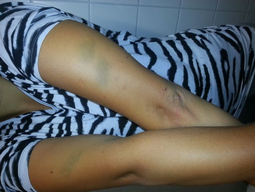 Запорожанку в Германии держит в заточении и избивает собственная тетя